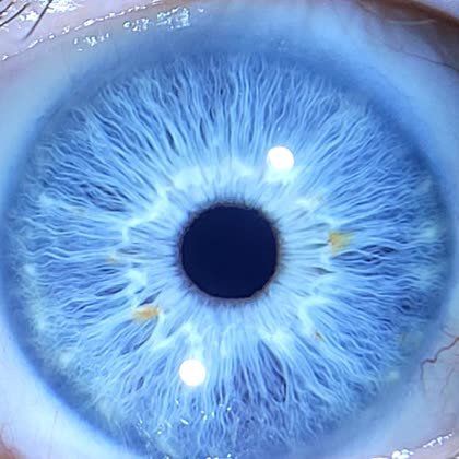 Íris azul cristalina com fibras brancas radiantes